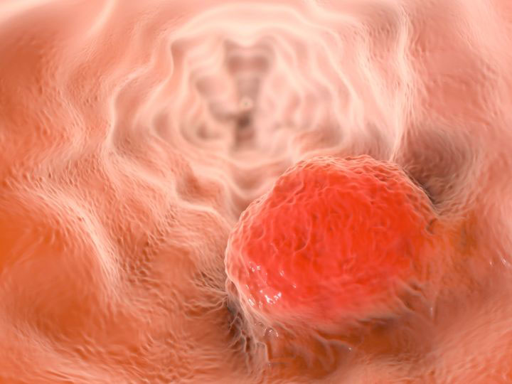 Esophageal Cancer